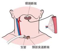 咽頭がん