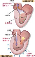 大動脈弁狭窄症